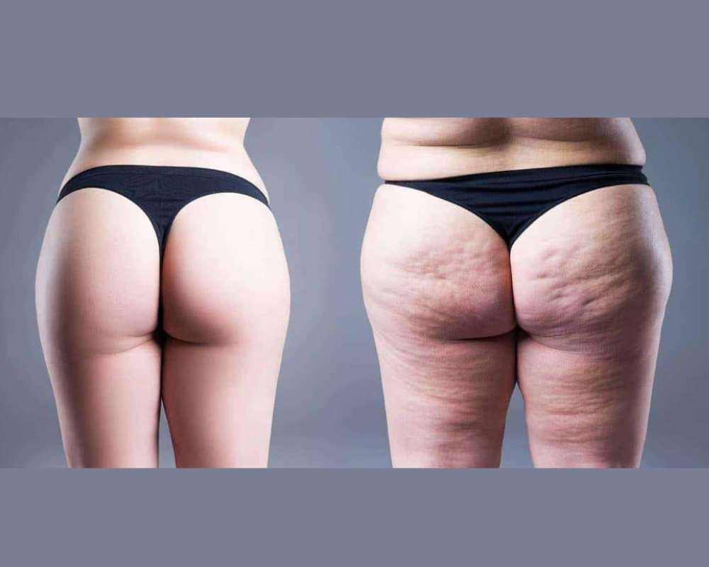 lipedema